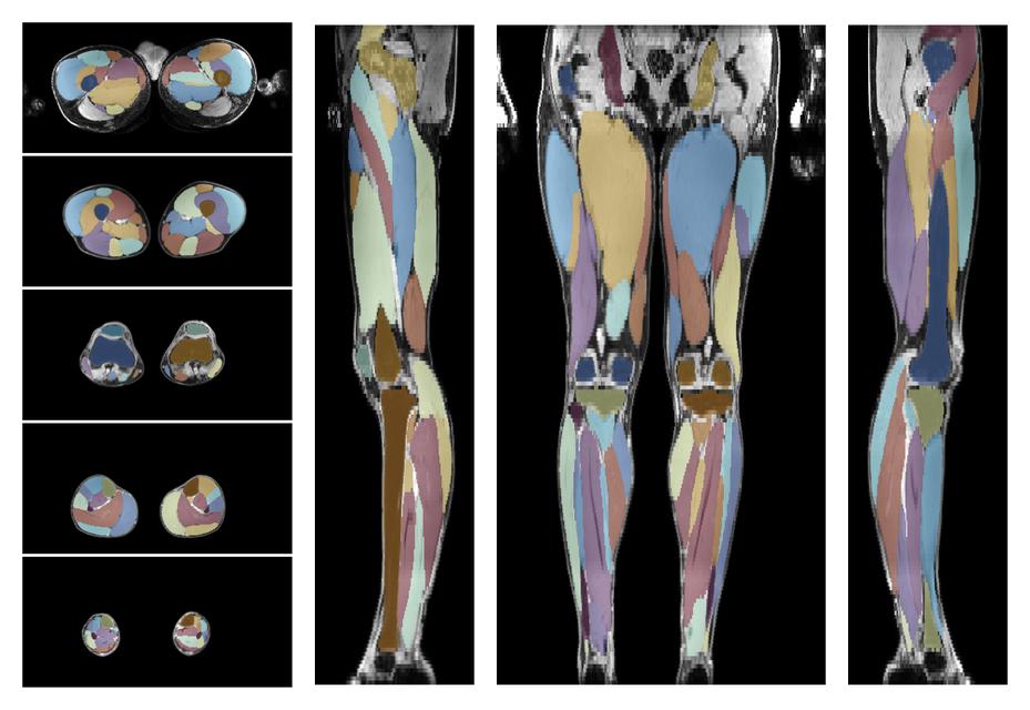 Overlay of automated muscle segmentation labels on dixon water image.